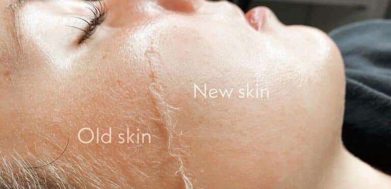 Dermaplaning